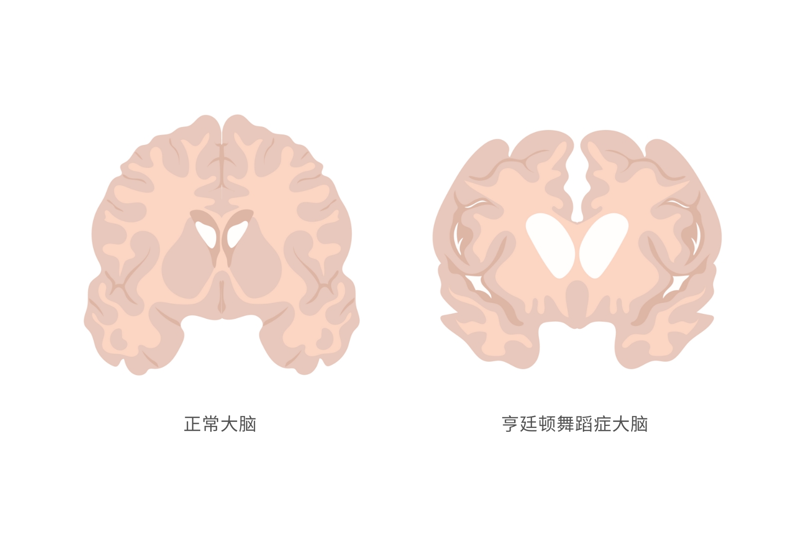 亨廷顿舞蹈症