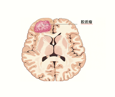 胶质瘤